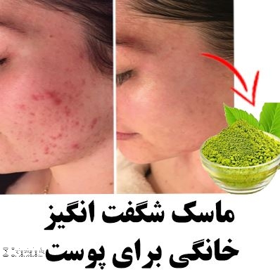 Le henn gurirait l'acn selon les Iraniennes
