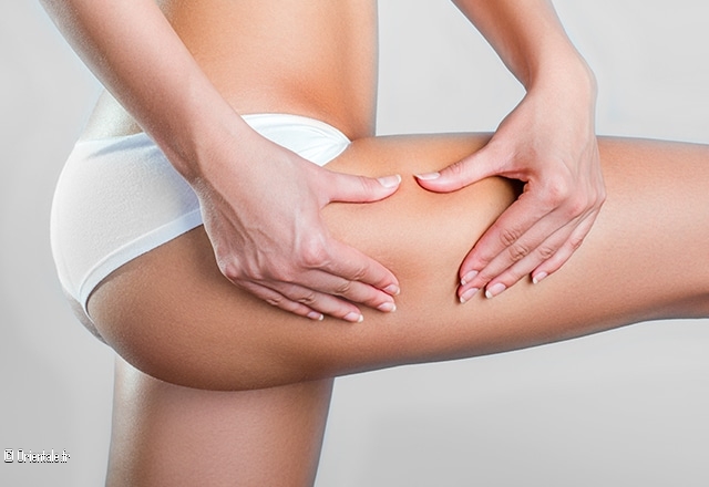 Cellulite Cellulite