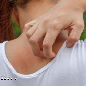 Choc anaphylactique du aux moustiques et tiques