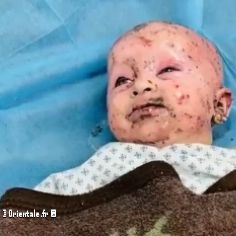 Un bébé palestinien blessé par du phosphore